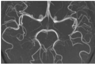 【直前予約可】基本脳ドック(頭部MRI/MRA・頸部MRA・簡易認知機能検査)
