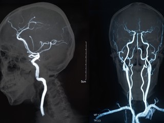 脳ドック(頭部MRI+頸動脈・頭蓋内動脈MRA検査)+血管年齢検査11