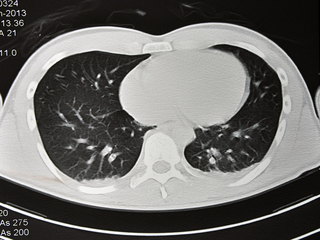 肺ドック(胸部CT、喀痰細胞診検査など)【肺機能精査レポート付き】11