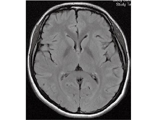 ベーシック脳ドック(MRI+MRA検査)11