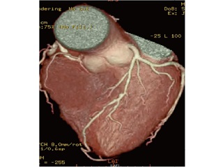 簡易CT心臓ドック(冠動脈CT検査/造影剤なし)