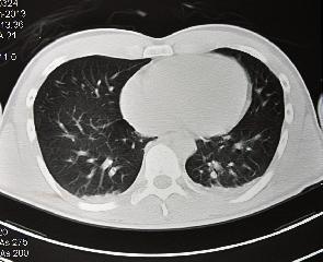 肺がん検査(肺CT+腫瘍マーカー)11