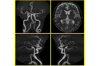 【平日午後プラン】脳ドック(シンプルプラン)  *頭部MRI+頭部MRA11