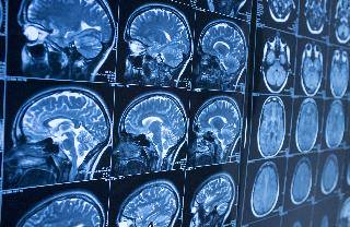 脳と頚椎をMRI・MRAで検査するオリジナル脳ドックBコース11