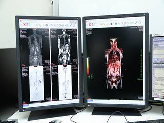 【膵臓がんチェックを含む全身がん検査】DWIBS+MRCP+上腹部MRI11