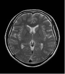 三宮駅近!脳ドック(MRI+MRA+頸動脈エコー)+認知症検査11