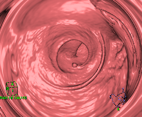 【CT単独検査】大腸カメラが苦手な方の大腸CT検査　(3D-CT仮想内視鏡検査)11