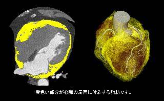 CTで行う心臓動脈硬化ドック◆当日結果説明付き!◆