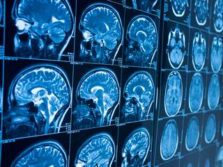【後日医師による結果報告あり】一般コース(頭部MRI・MRA+頚動脈エコー検査+血圧脈波検査+高次脳機能検査 +心電図+血液検査+尿検査)　