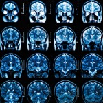頭部MRIとMRAの違いって何？ どんな病気を見つけられるの？